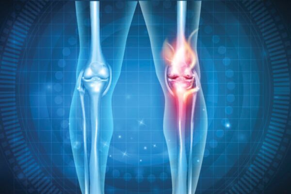 Joint issues & Chronic pain