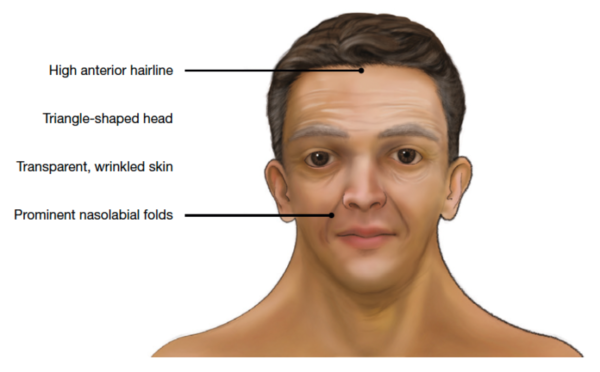 FAQs Facial Features Noonan Syndrome Association
