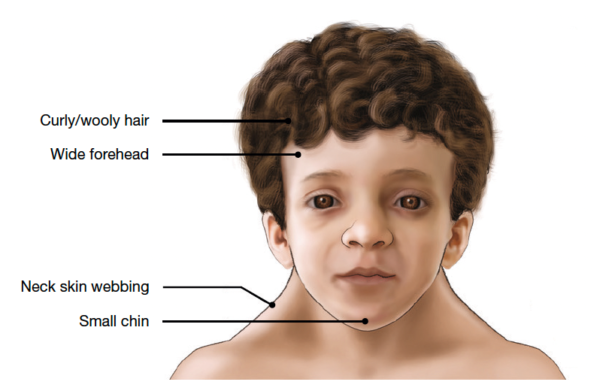 FAQs Facial Features Noonan Syndrome Association